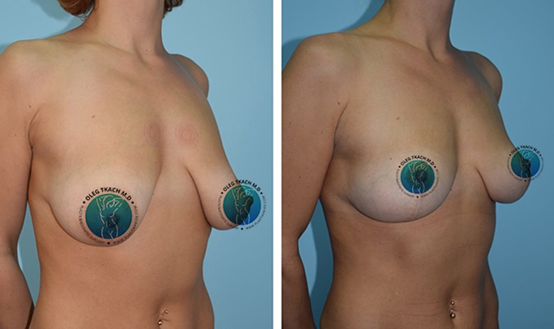 Фото до и после Уменьшение груди 17