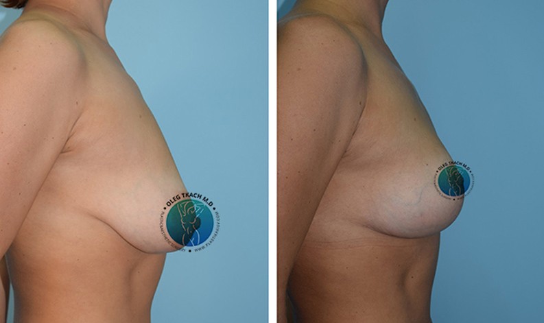 Фото до и после Уменьшение груди 18