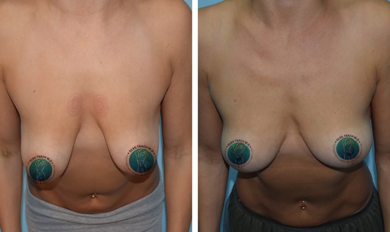 Фото до и после Уменьшение груди 19