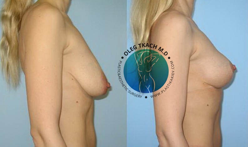 Фото до и после Уменьшение груди 22