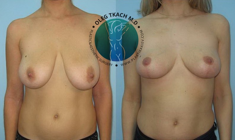 Фото до и после Уменьшение груди 23