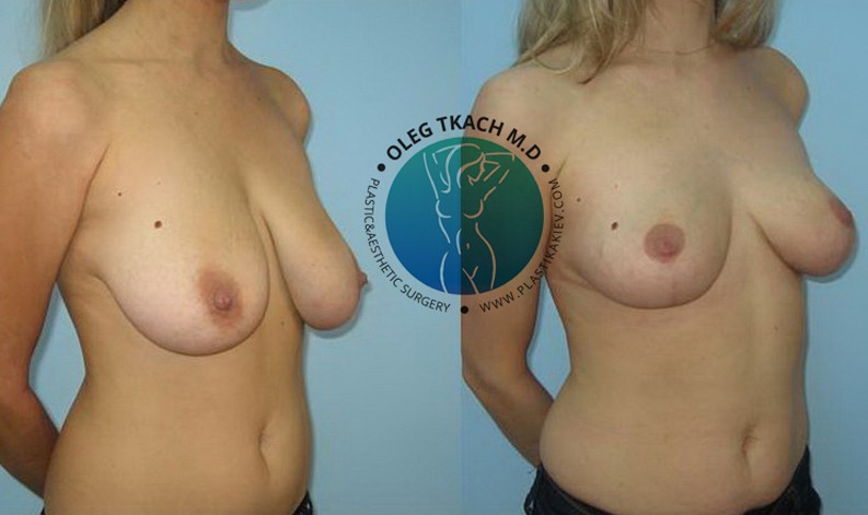 Фото до и после Уменьшение груди 24