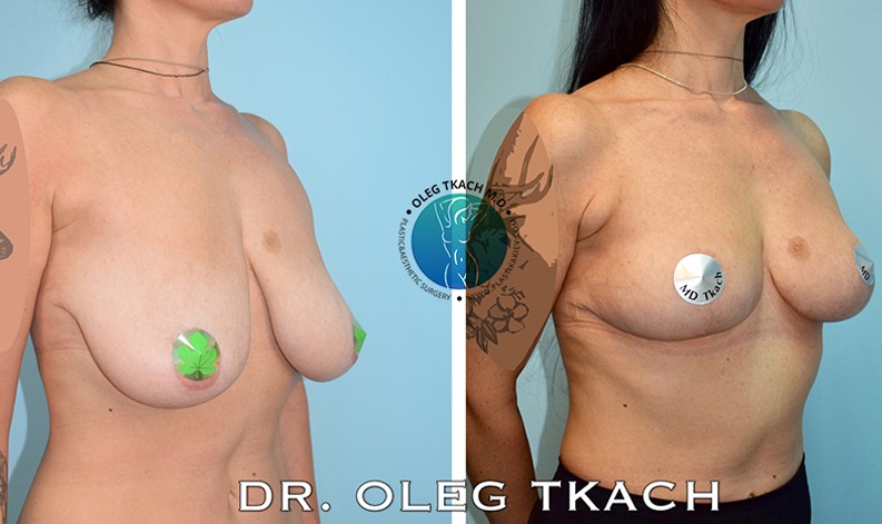 Фото до и после Уменьшение груди 27