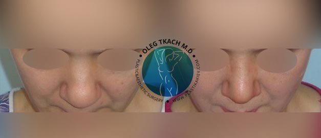 Фото до и после Ринопластика (пластика носа) 65