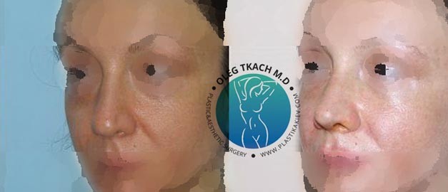 Фото до та після Ринопластика (пластика носа) 72
