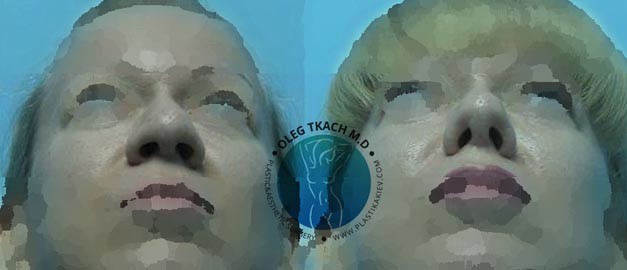 Фото до и после Ринопластика (пластика носа) 76
