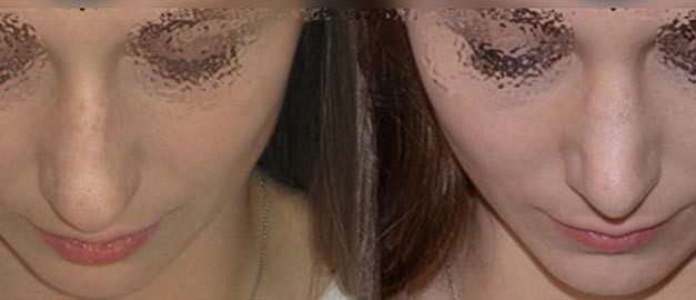 Фото до и после Ринопластика (пластика носа) 83
