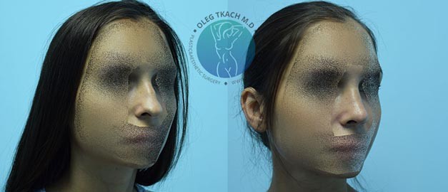 Фото до и после Ринопластика (пластика носа) 90