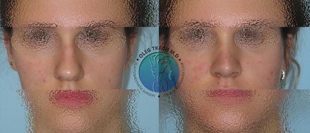 Фото до та після Ринопластика (пластика носа) 106