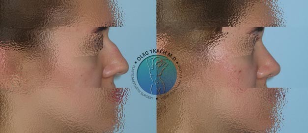 Photos before and after Rhinoplasty 107