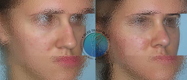 Photos before and after Rhinoplasty 108