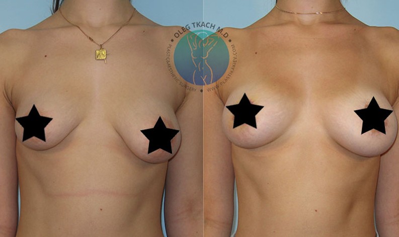 Фото до и после Уменьшение груди 29