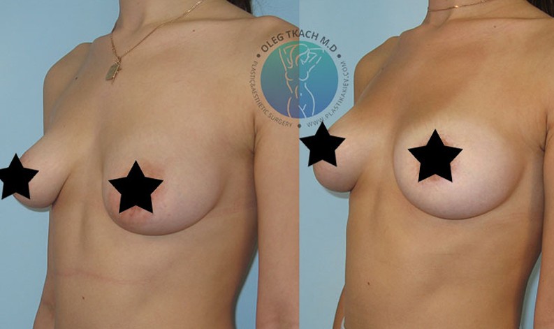 Фото до и после Уменьшение груди 30