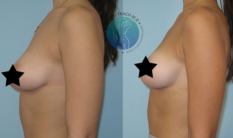 Фото до и после Уменьшение груди 31