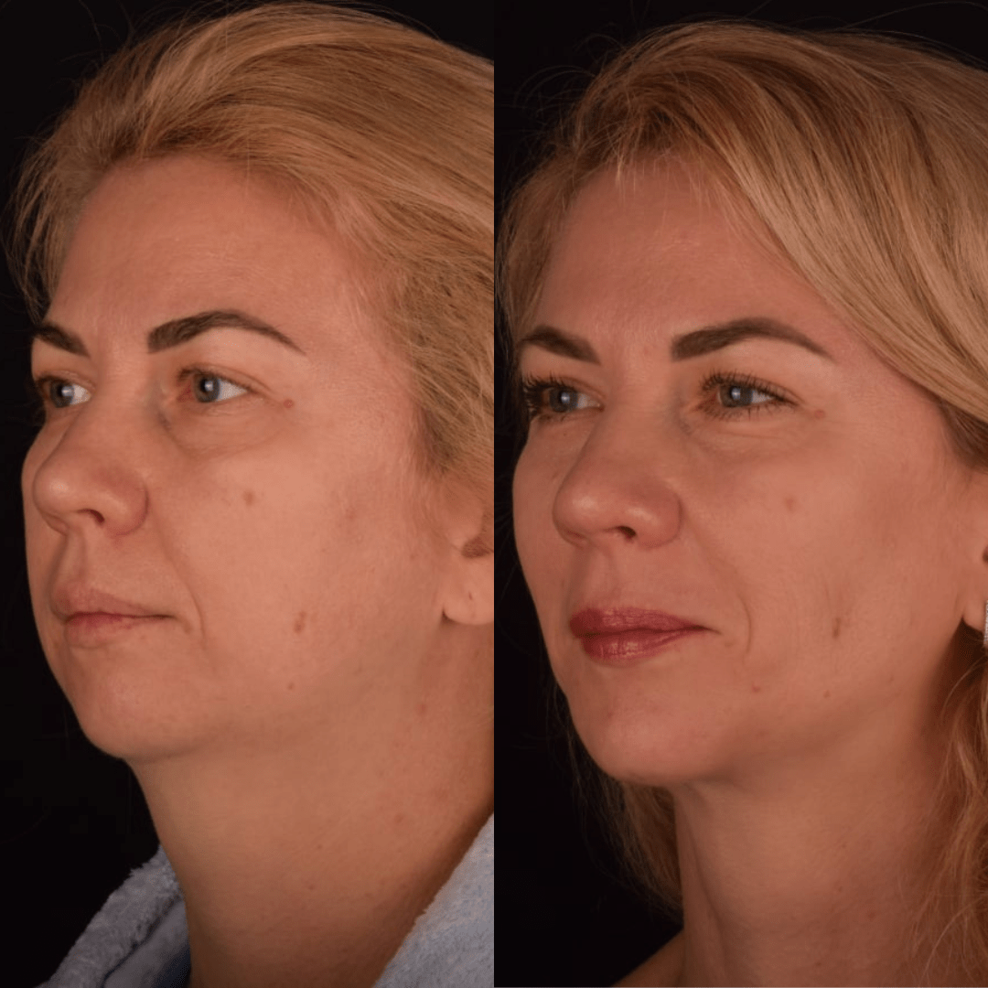 Фото до и после Костная/контурная пластика лица 7