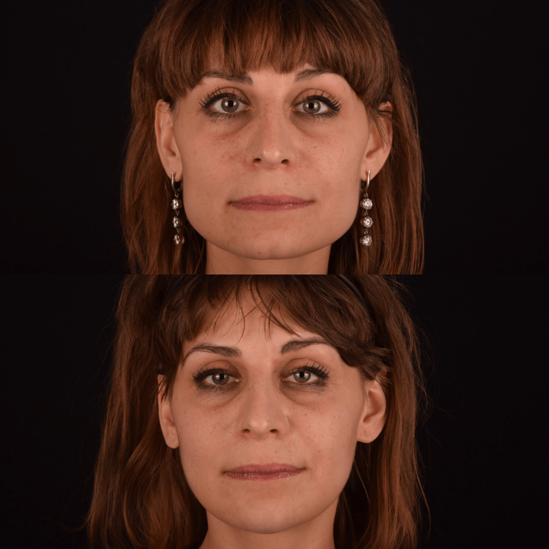 Фото до и после Костная/контурная пластика лица 1