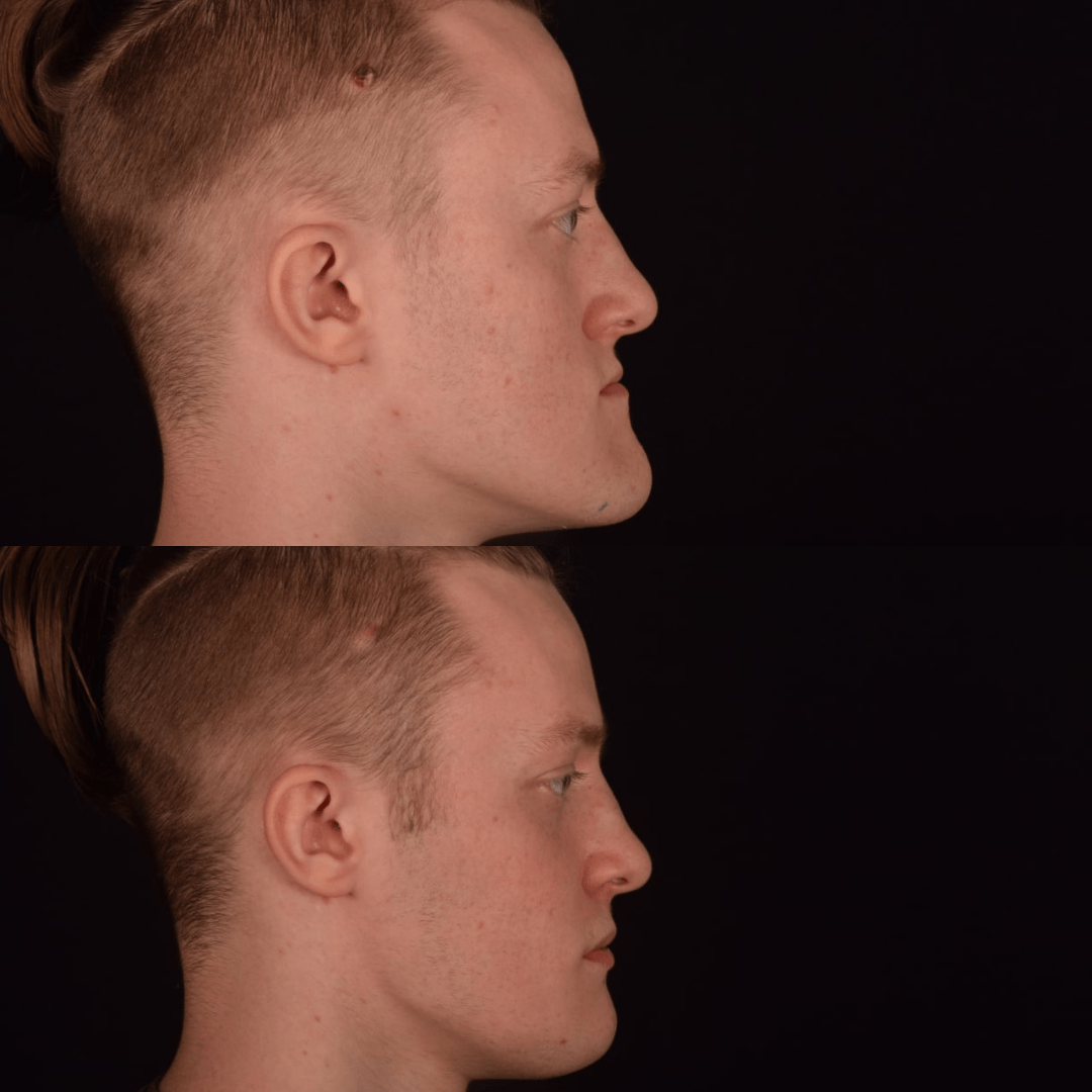 Фото до та після Кісткова пластика обличчя 3