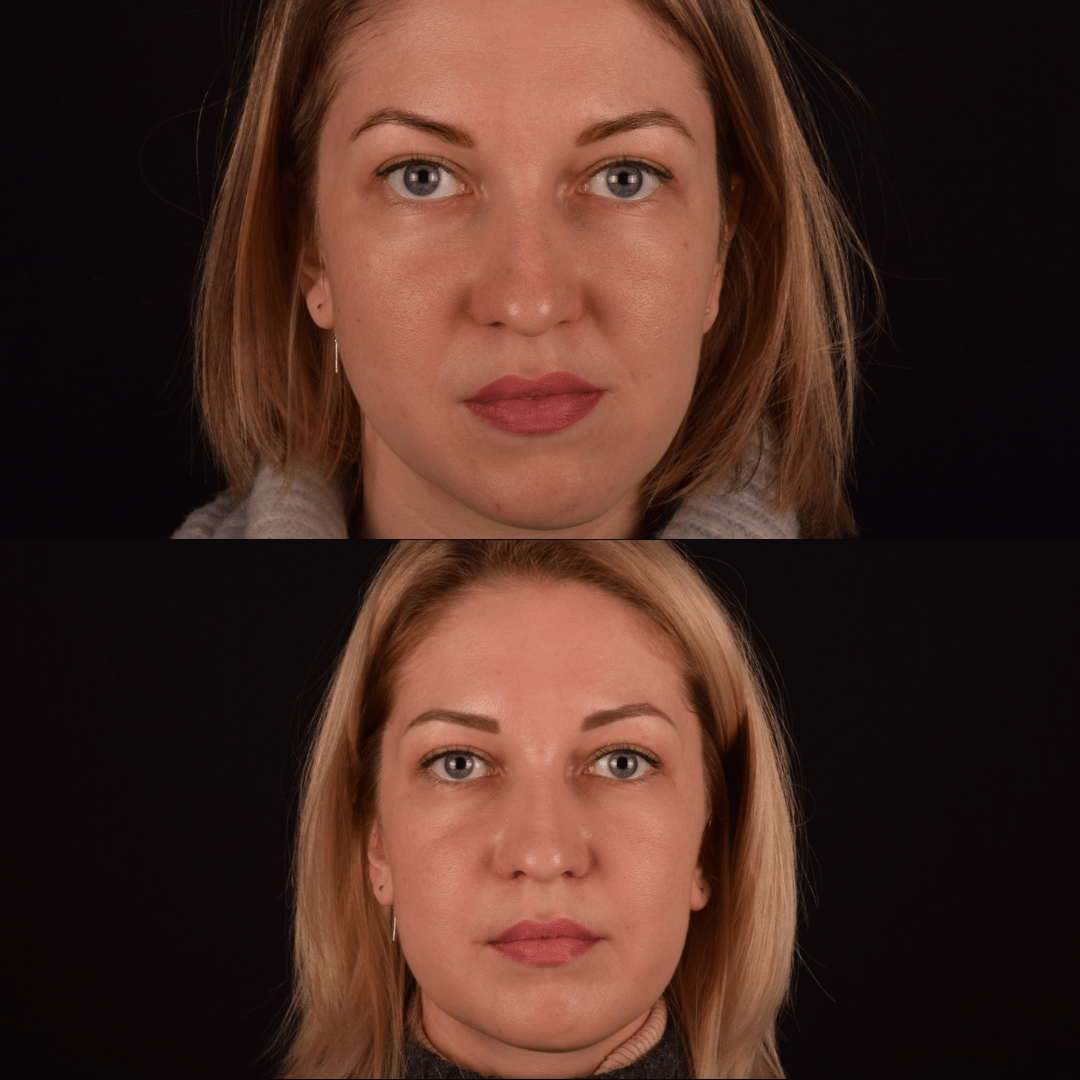 Фото до и после Костная/контурная пластика лица 8