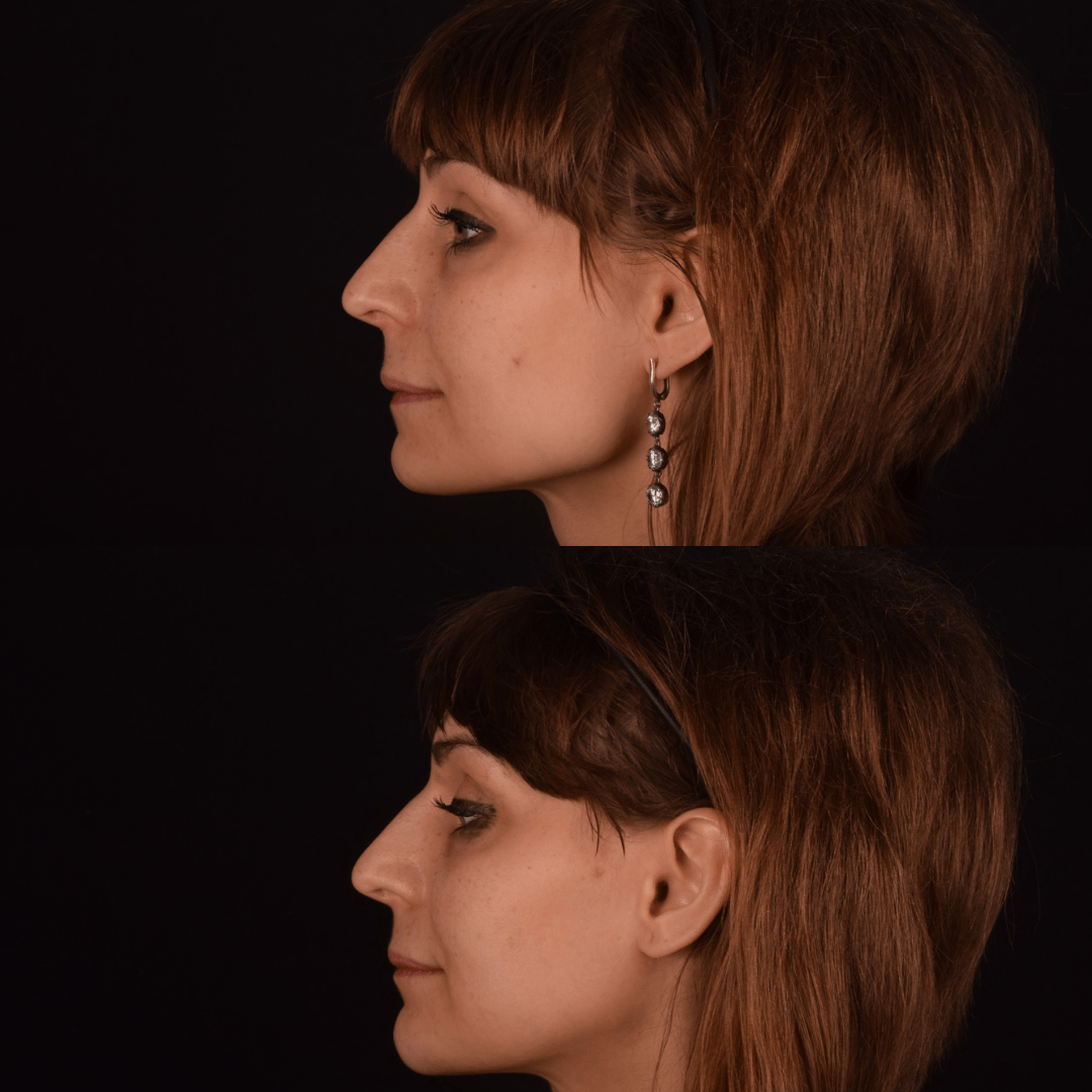 Фото до та після Кісткова пластика обличчя 2