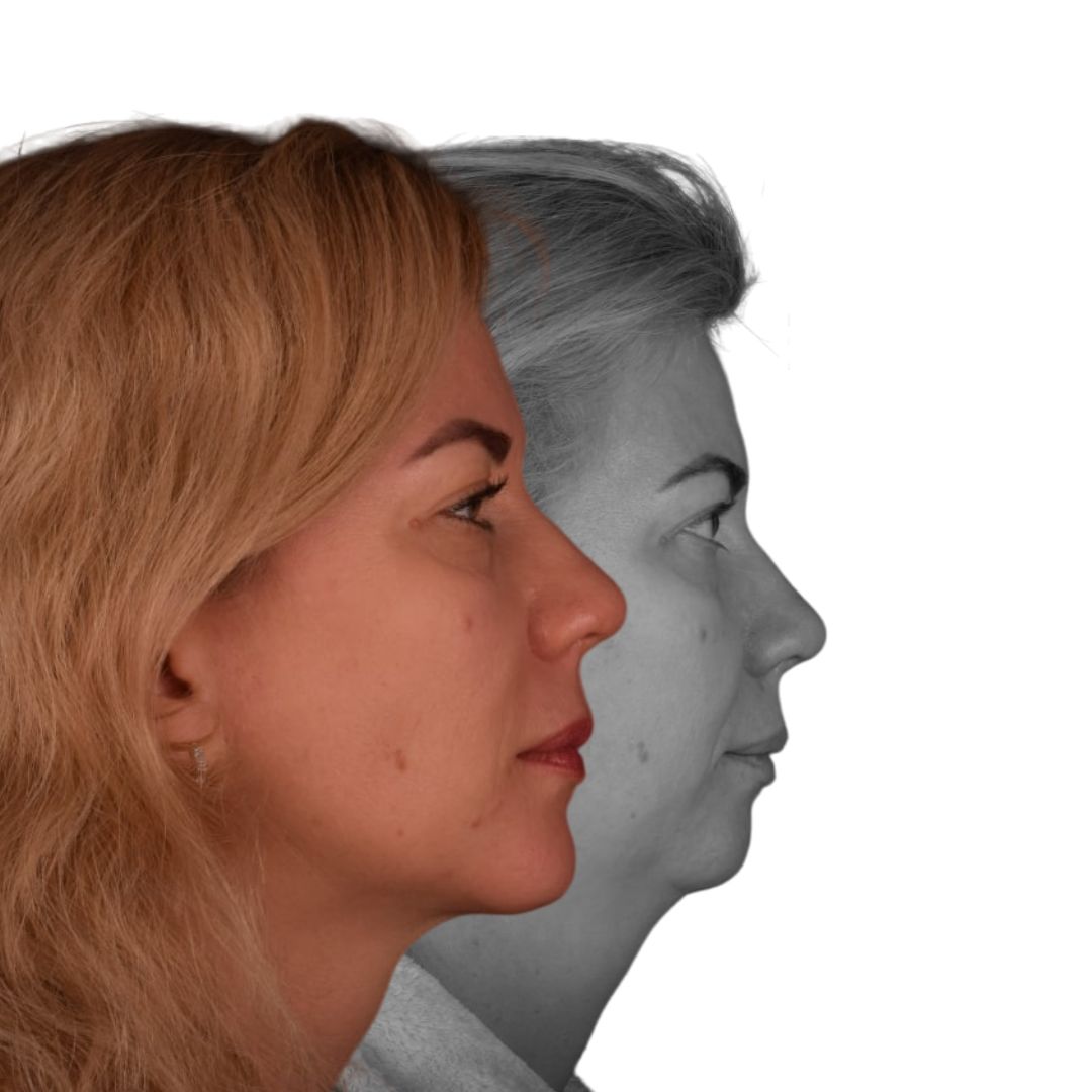 Фото до та після Кісткова пластика обличчя 6