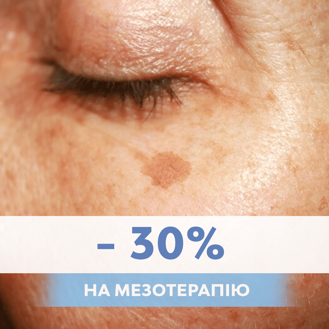 PROMOTION -30% discount on mesotherapy