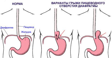 Operaciyi Pri Diafragmalnij Grizhi Certus