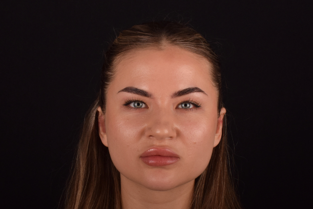 Корекція клаповухості 11